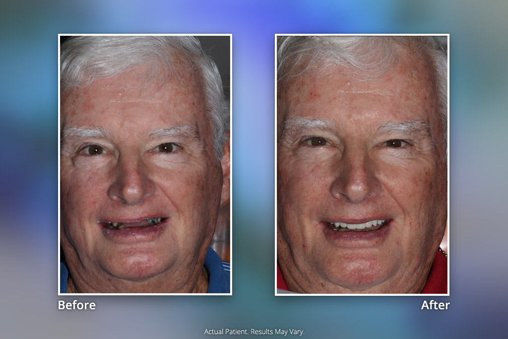 Specialists in Implant Dentistry Smile Gallery Before & After