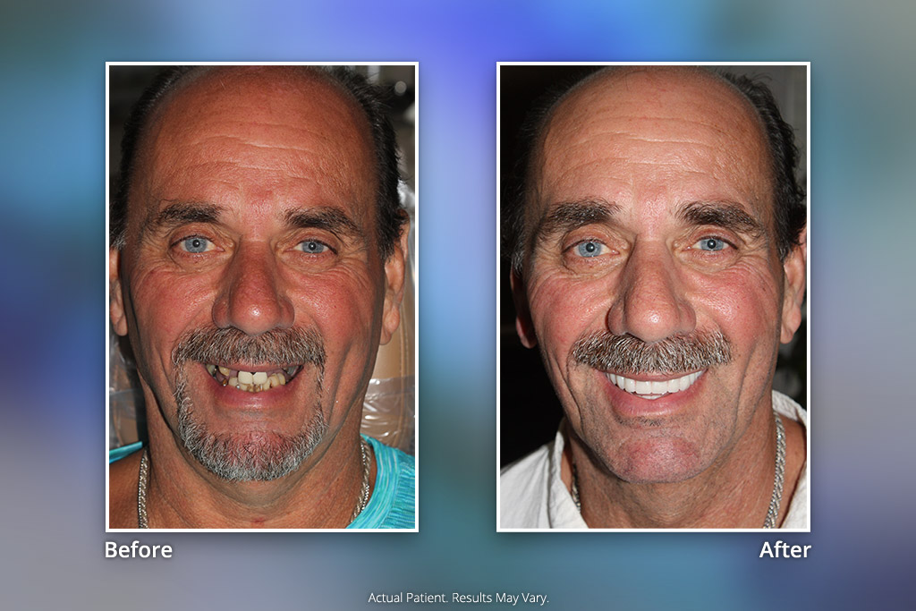 Specialists in Implant Dentistry Smile Gallery Before & After